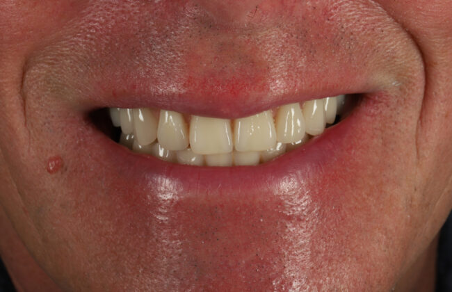 After (Teeth)