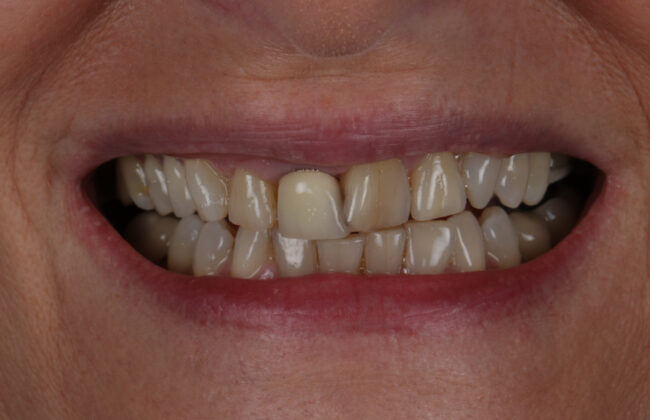 Before (Teeth)