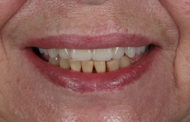 Before (Teeth)