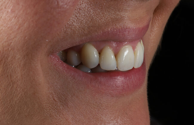 After (Teeth)