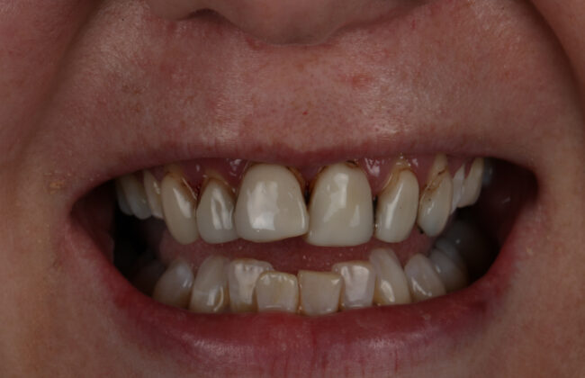 Before (Teeth)