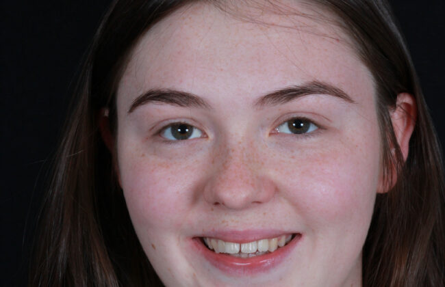 Before (Teeth)