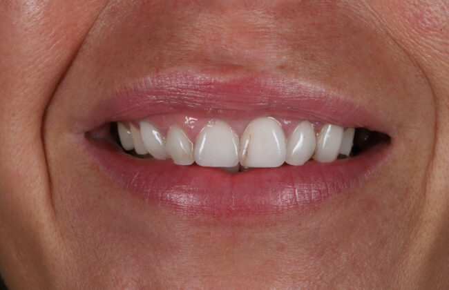 Before (Teeth)