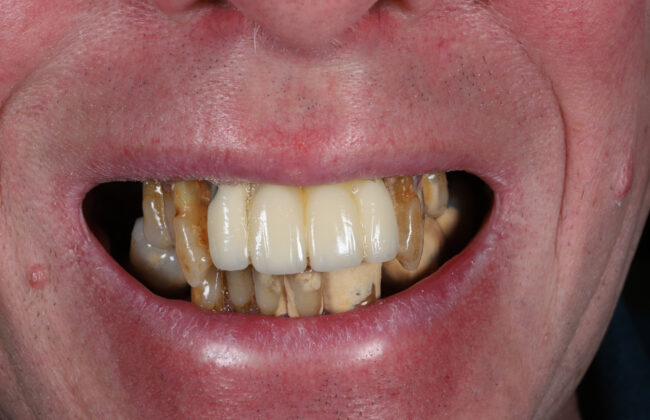 Before (Teeth)
