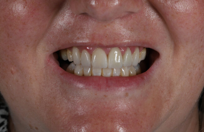 After (Teeth)
