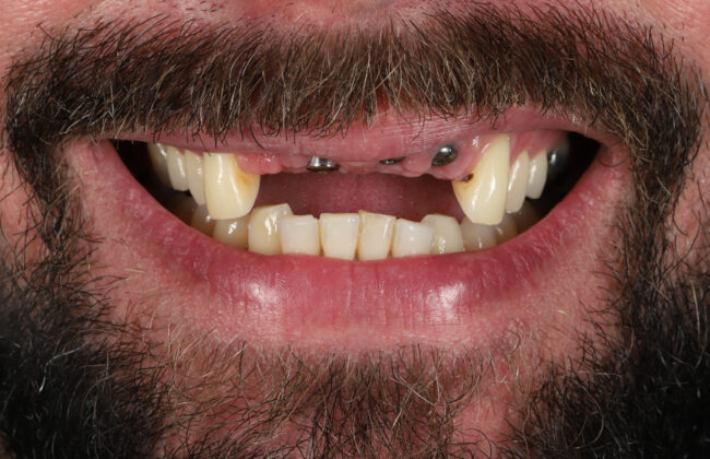 Before (Teeth)
