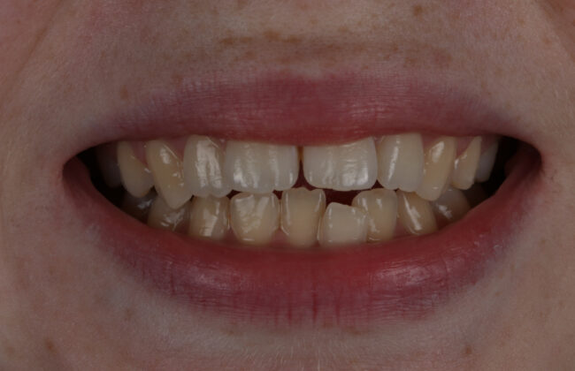 Before (Teeth)