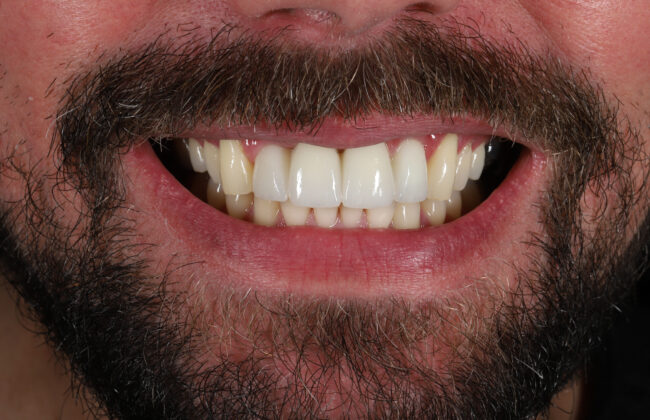 After (Teeth)