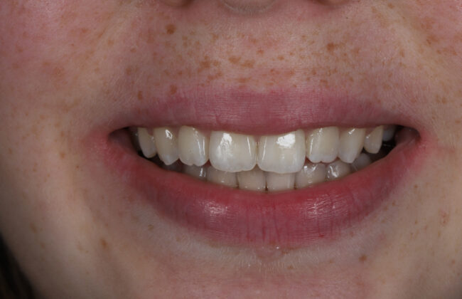 After (Teeth)