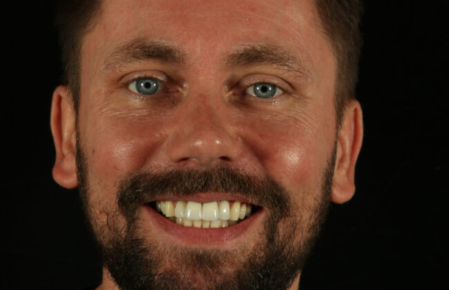 After (Teeth)