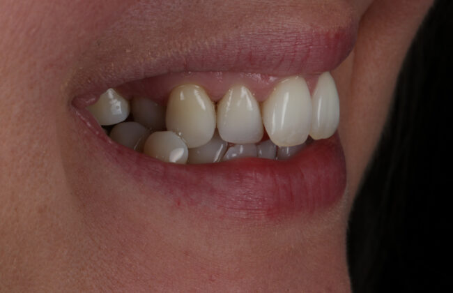 Before (Teeth)