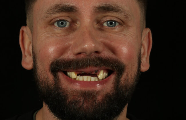 Before (Teeth)