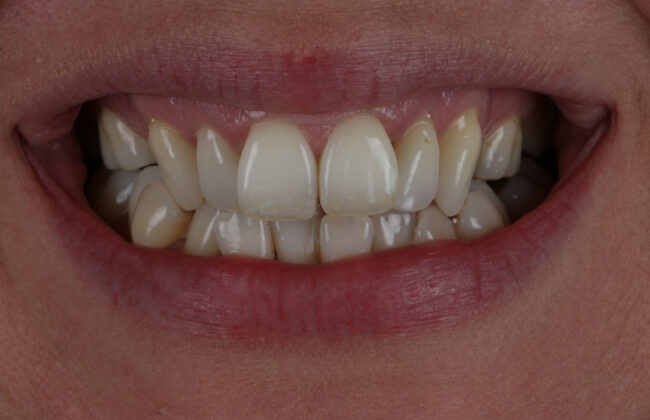 Before (Teeth)