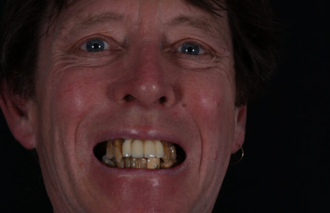 Before (Teeth)
