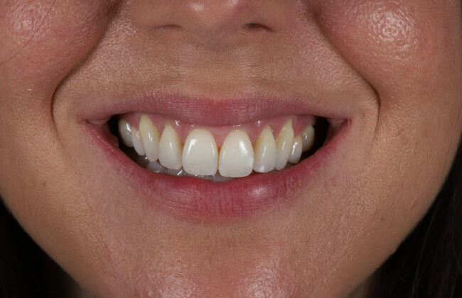 After (Teeth)