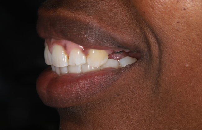 Before (Teeth)