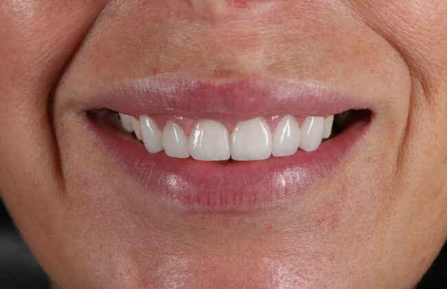 After (Teeth)