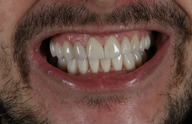 After (Teeth)