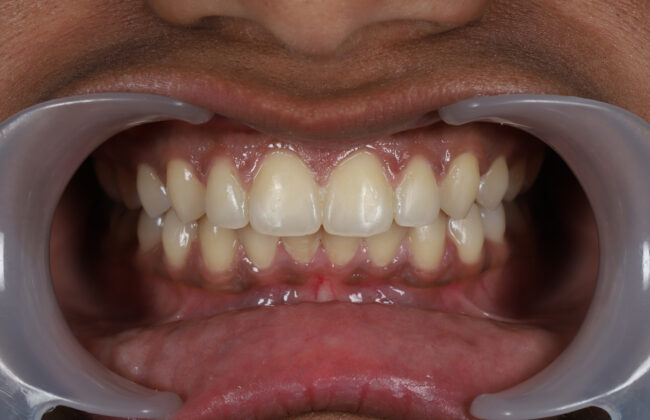 After (Teeth)