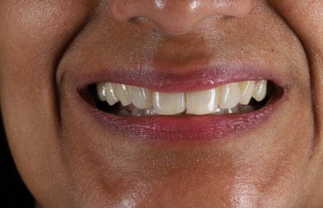 After (Teeth)