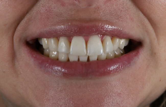 After (Teeth)