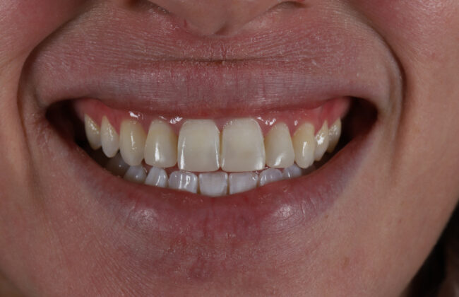 After (Teeth)