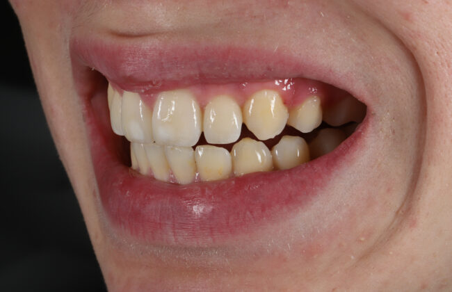 After (Teeth)