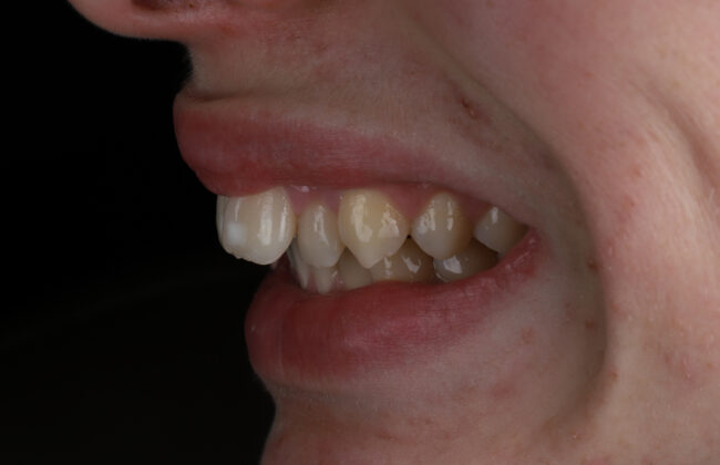 Before (Teeth)