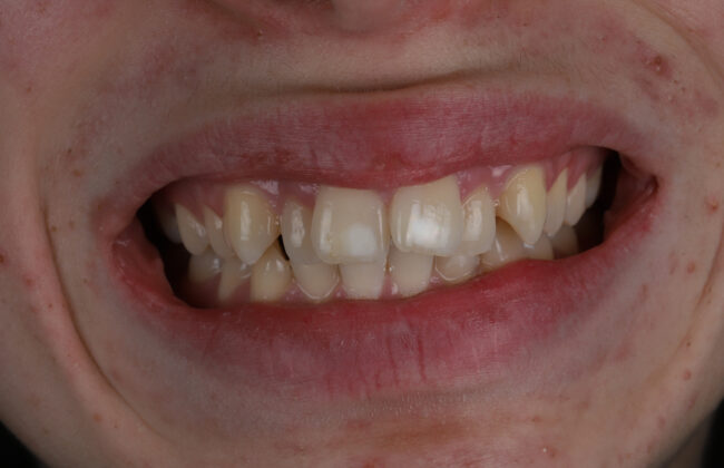 Before (Teeth)