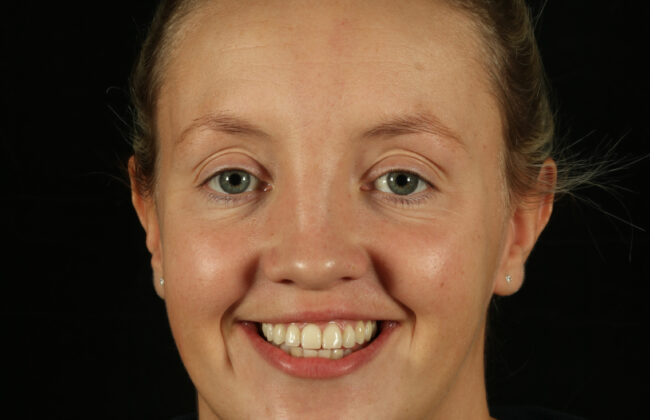 After (Teeth)