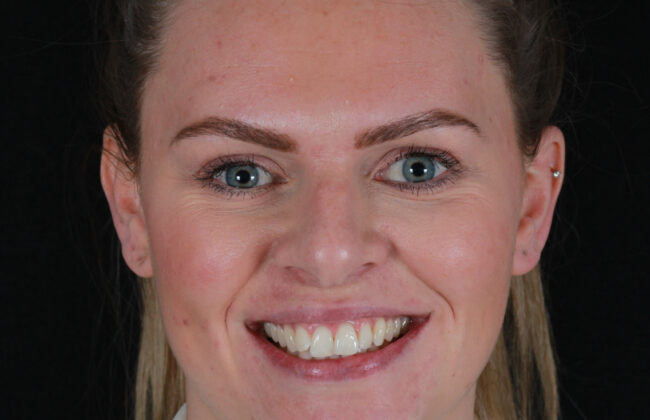 Before (Teeth)