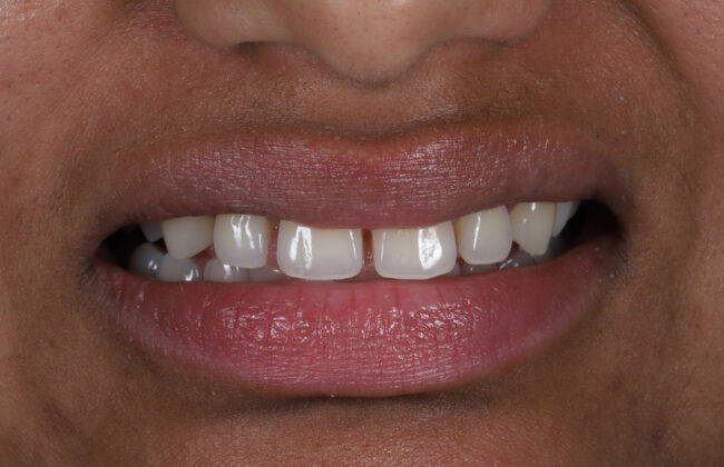 Before (Teeth)