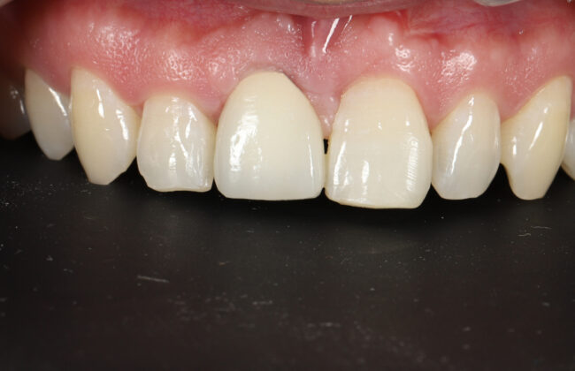 After (Teeth)