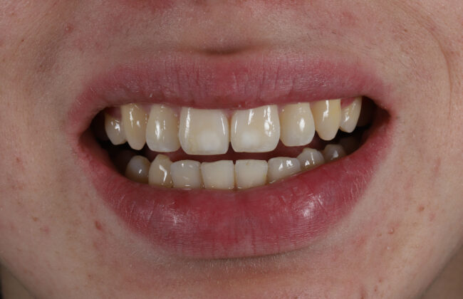 After (Teeth)