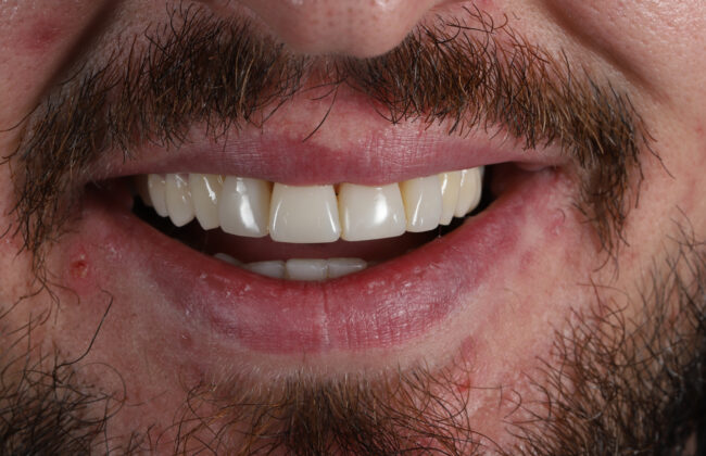 After (Teeth)