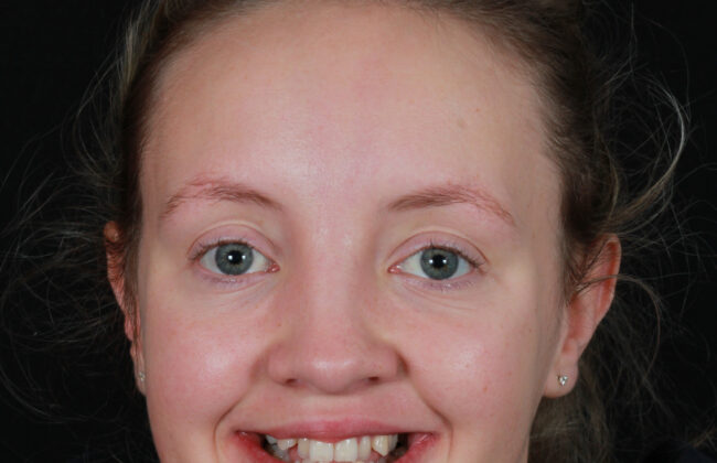 Before (Teeth)