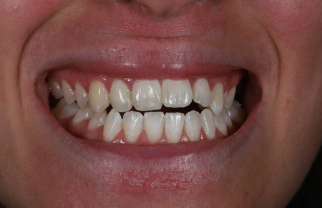 Before (Teeth)
