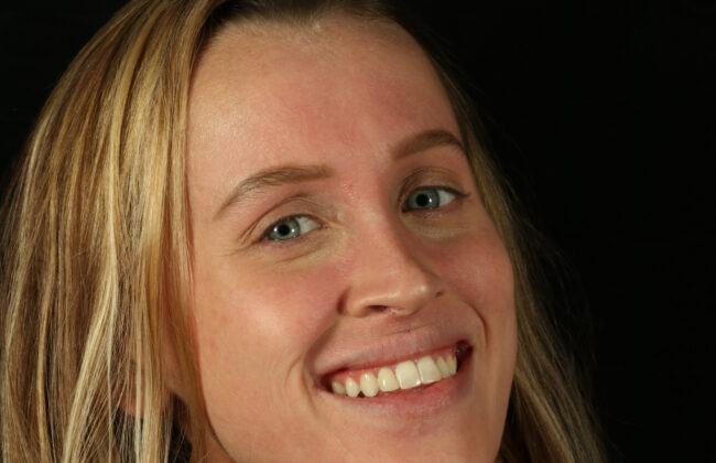 After (Teeth)