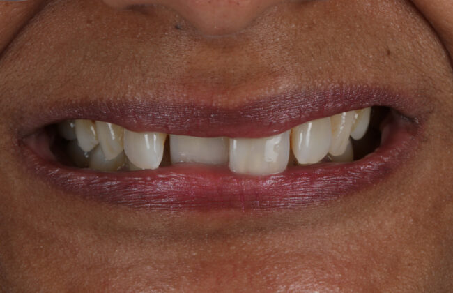 Before (Teeth)