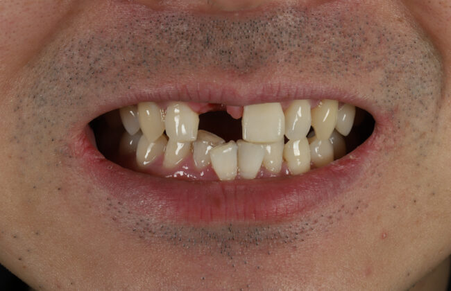 Before (Teeth)