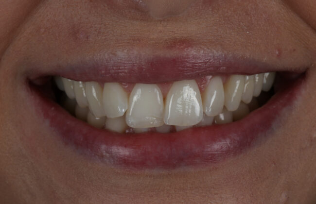 Before (Teeth)