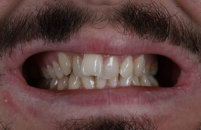 Before (Teeth)