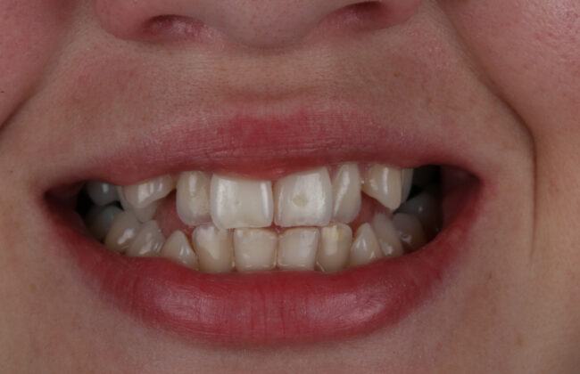 Before (Teeth)