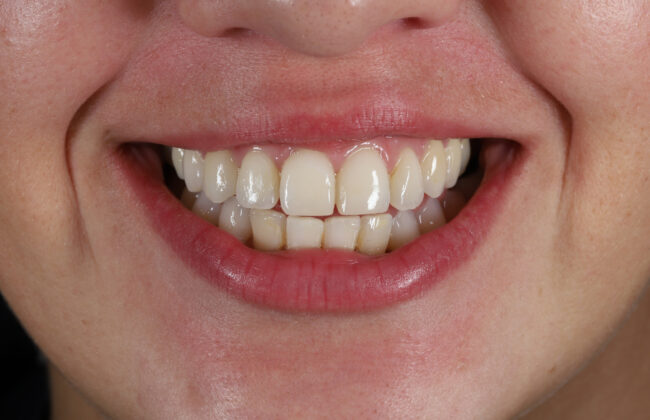 After (Teeth)