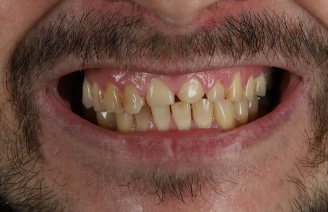 Before (Teeth)