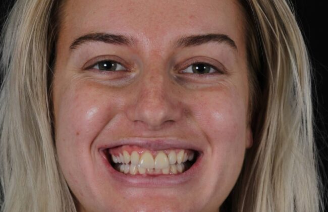 Before (Teeth)