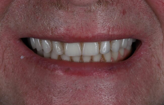 After (Teeth)