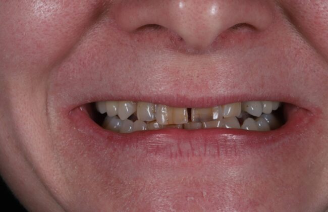 Before (Teeth)