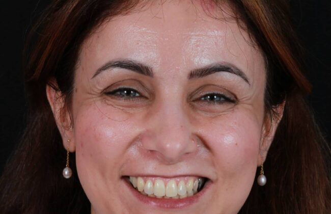 After (Teeth)