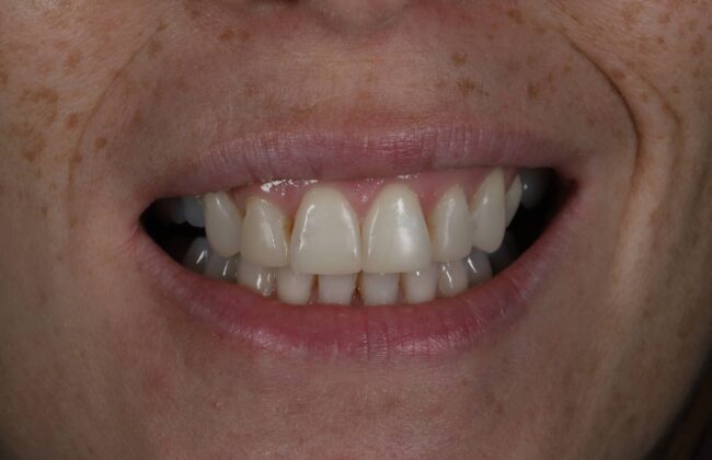 After (Teeth)